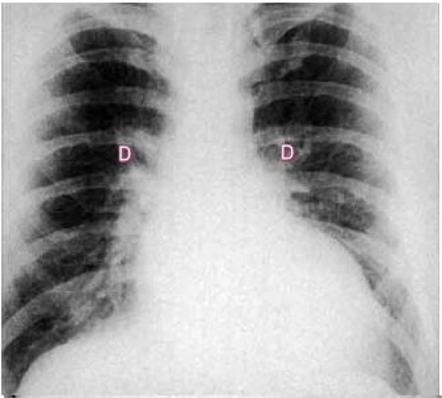 Skiagram u koarktace ukazuje zvětšené srdce s dilatací levé síně a žil horních laloků, svědčící pro plicní žilní hypertenzi.