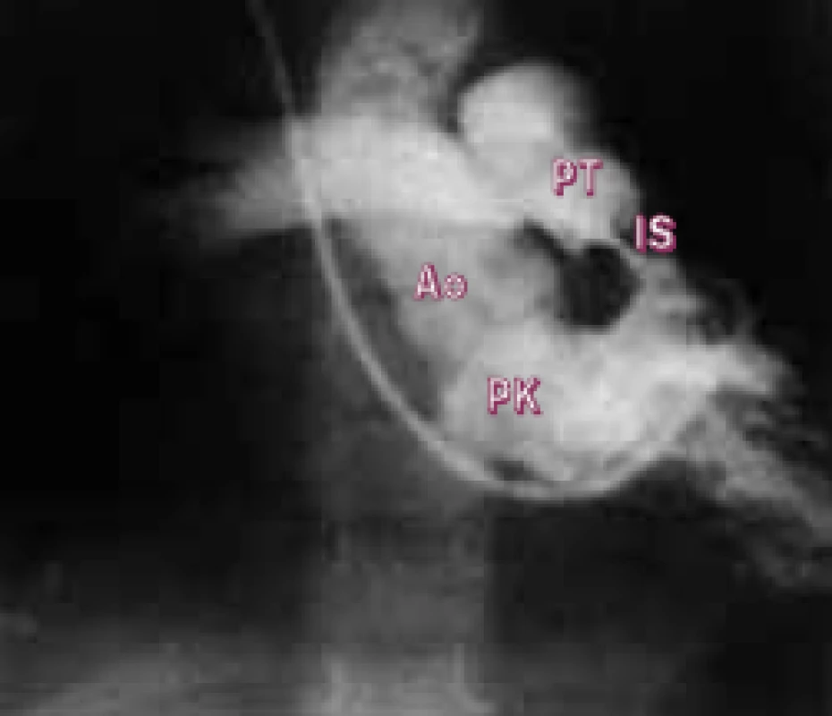 Ventrikulogram PK v antero–posteriorní projekci ukazuje infundibulární stenózu s nasedající aortou.
