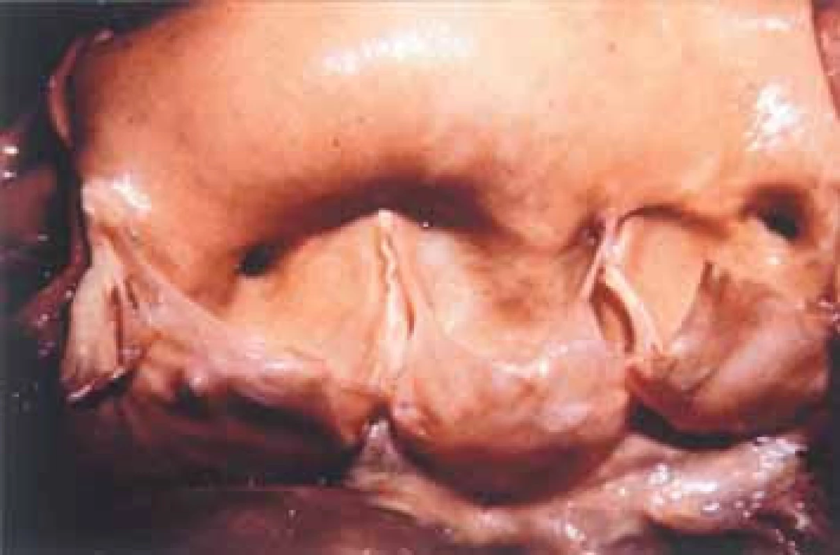 Dilatovaný kořen aorty s tenkými balonovitými cípy působícími aortální regurgitaci u Marfanova syndromu.