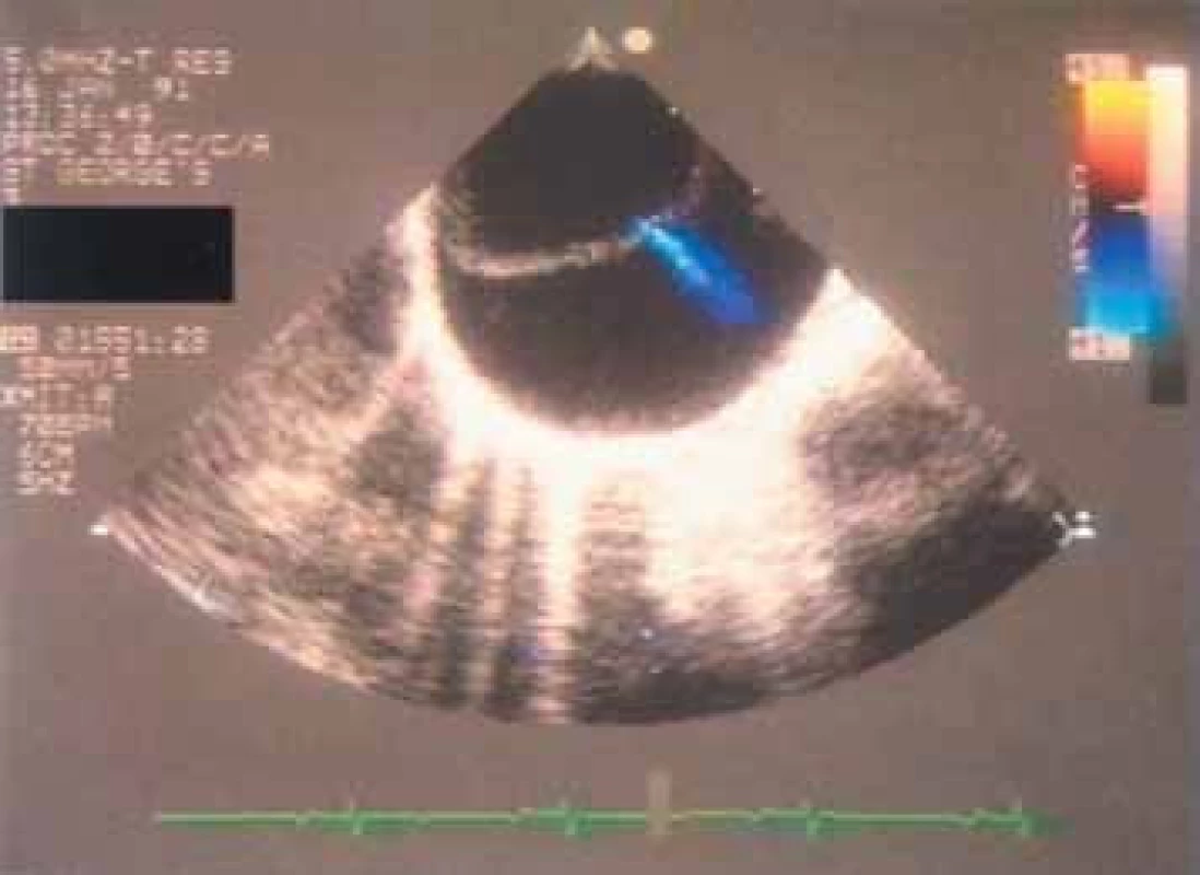 Transezofageální studie případu aortální direkce: (a) Transverzální řez právě nad cípy chlopně ukazuje značně dilatovanou aortu s disekovanou intimou na více než 80 % cirkumference. Disekce je zřetelně omezena ústím levé věnčité tepny. Značně větší falešné lumen je vyplněno spontánním echokontrastem. (b) Transverzální sekce u stejného pacienta ukazuje disekci šířící se do descendentní hrudní aorty. U barevného dopplerovské echokardiografie je normální, že ukazuje několik malých jetů vstupujících do falešného lumen. Nereprezentují primární intimální trhlinu, ale vznikají z perforací na začátku malých tepenných větví.
