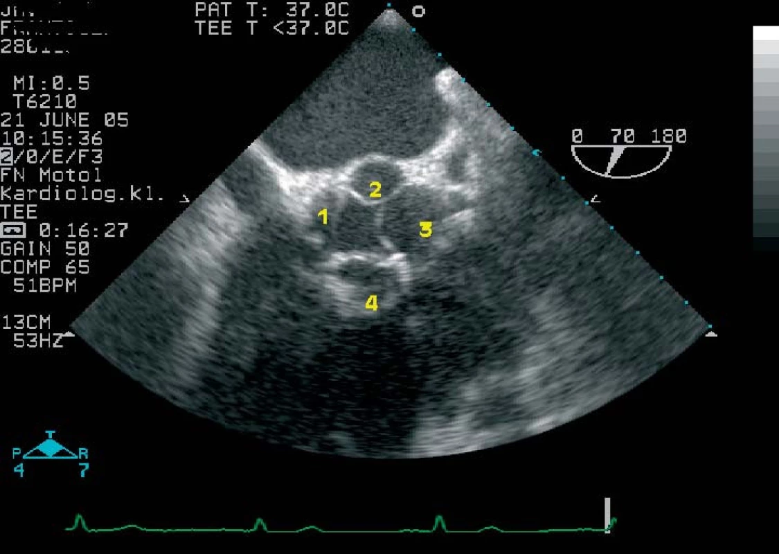 Jícnová echokardiografie. Pohled na bázi srdeční v rovině aortální chlopně ukazuje čtyřcípou aortální chlopeň (typ C) s 2 menšími cípy (čísla 1, 2) a 2 většími cípy (čísla 3, 4).