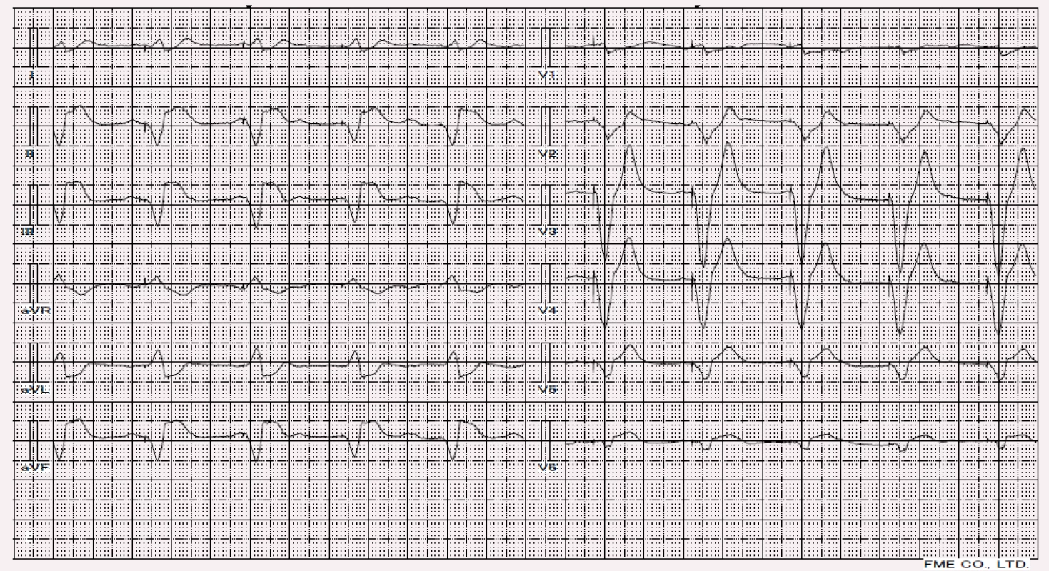 Akutní infarkt myokardu u pacient se stimulovaným QRS komplexem (Ve svodech nad dolní stěnou najdeme ST elevace, ve svodu V1 a V2 najdeme ST deprese).