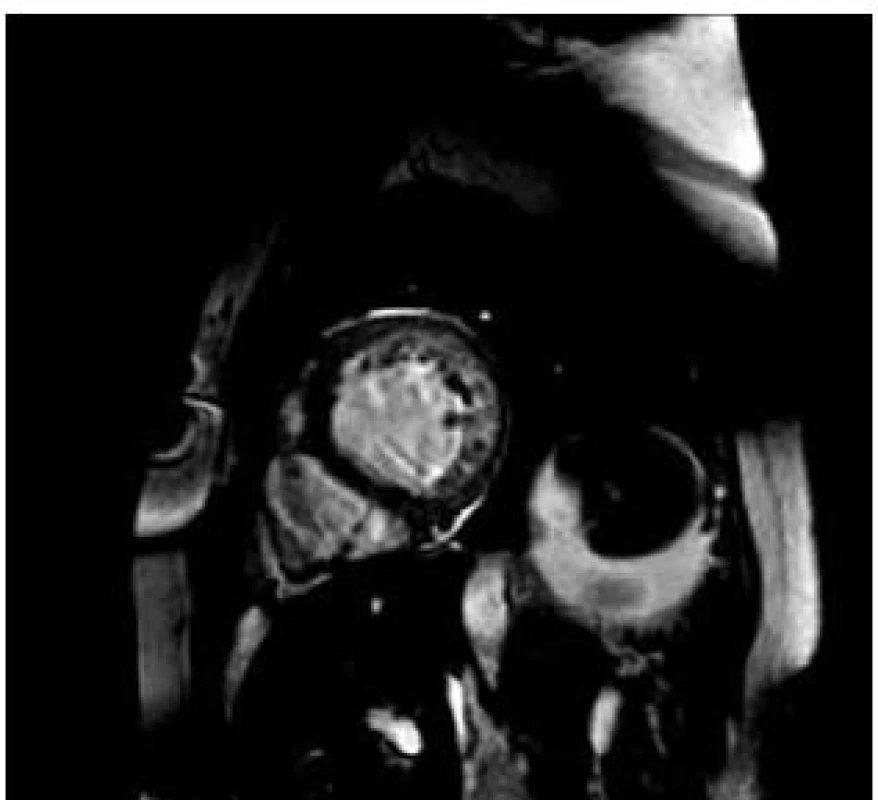 Srdeční magnetická rezonance (leden 2010) – krátký řez na levou komoru. Patrna hypertrabekulizace laterální, zadní a spodní stěny. Síla nonkompaktního myokardu (výše trabekul) v diastole je větší než 2,3 v poměru ke kompaktní vrstvě svaloviny. Splňuje tedy kritéria nonkompaktní kardiomyopatie levé komory (LVNC).