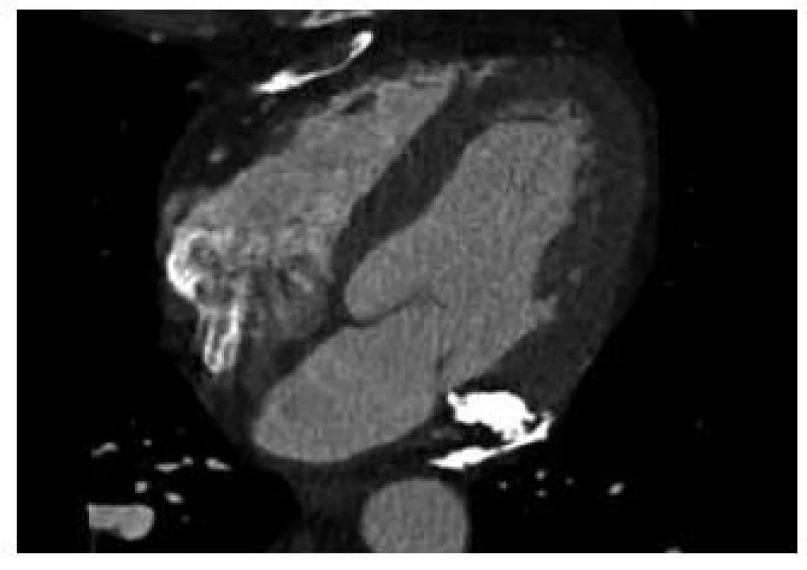 CT vyšetření srdce s kalcifikacemi v perikardu s přechodem do myokardu v sulcus atrioventricularis.