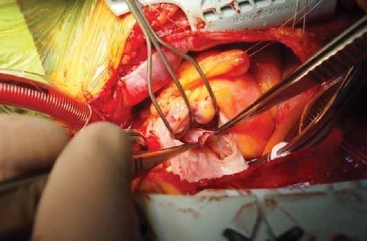 Pohled z otevřené pravé předsíně, v pinzetách aneuryzma s perforaci (průměr minimálně 5 mm) v jeho vrcholu. Vlevo arteriální kanyla z mimotělního oběhu směřující do ascendentní aorty, vpravo venózní kanyla do dutých žil.