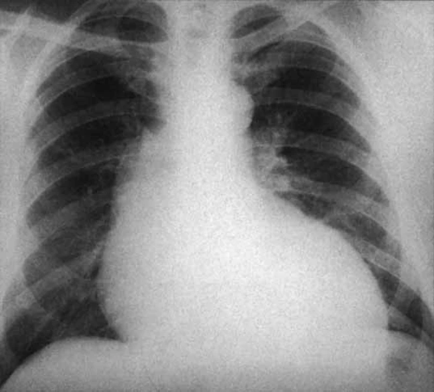 RTG hrudníku ukazuje dilataci vzestupné aorty a srdeční rozšíření u aortální regurgitace.