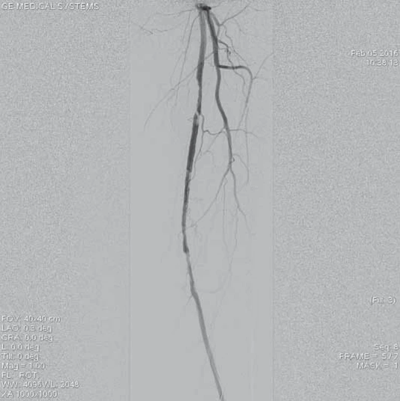 Kontrolní angiografie po opakovaných pasážích systému Rotarex&lt;sup&gt;®&lt;/sup&gt; 6F skrz uzávěr prokazuje reziduální stenotizace v proximálním a distálním konci uzávěru.