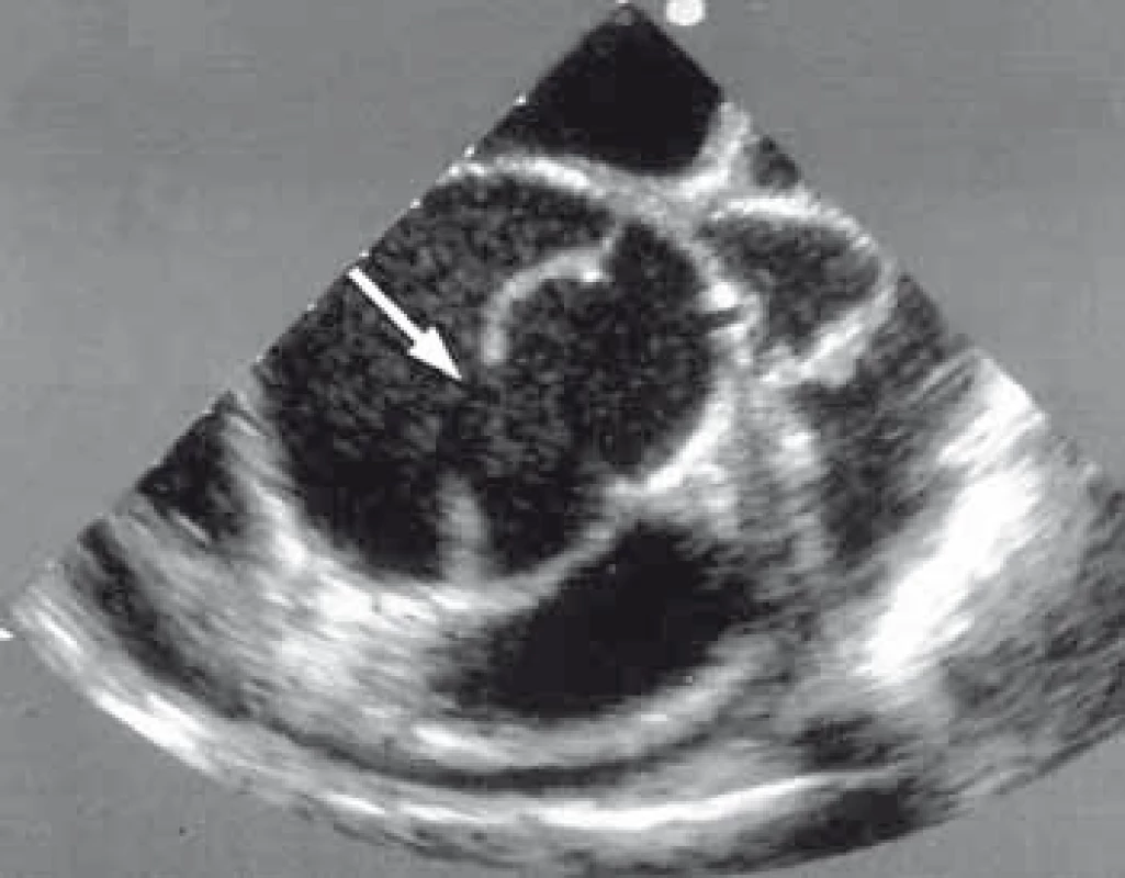Obraz transezofageální ultrasonografie zobrazující disekci sestupné hrudní aorty s velkým primárním entry (šipka) za odstupem levé podklíčkové tepny.