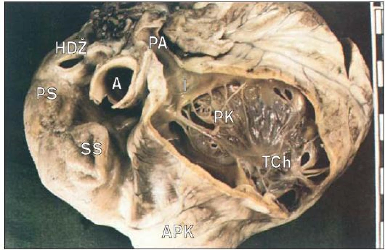 Srdce s Ebsteinovou anomálií trikuspidální chlopně v pohledu z odtokové části pravé komory. Chlopeň je fenestrovanou záclonou poutanou takovým způsobem, že odděluje přítokovou a odtokovou část pravé komory. Dutina přítokové části (atrializovaná pravá komora) je za chlopní.