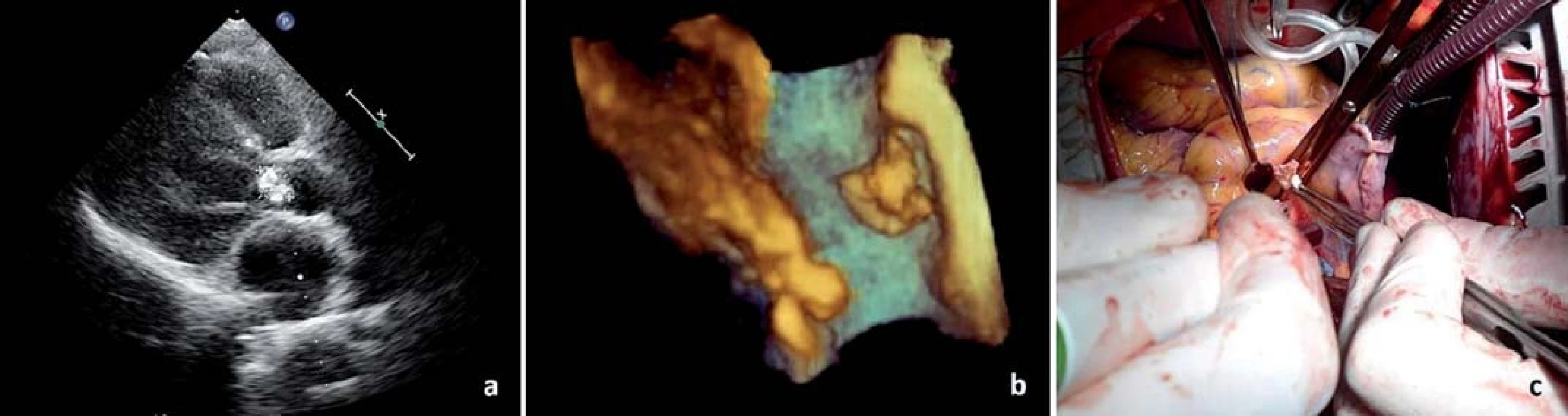 Vegetace na aortální chlopni pohledem: a) 2D echokardiografi e, b) 3D echokardiografi e a c) peroperačně. 
