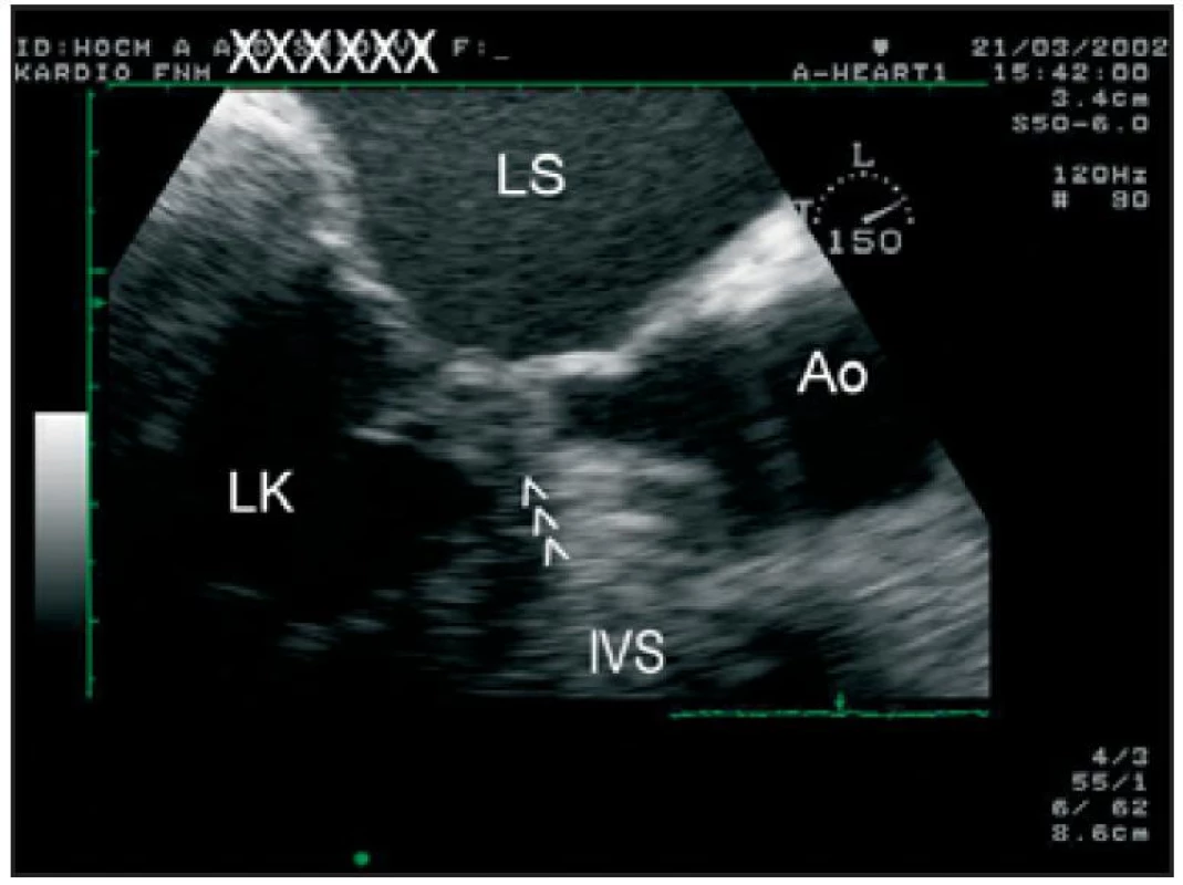Transezofageální echokardiografie, zoom na oblast výtokového traktu LK. Je přítomen dopředný pohyb předního cípu mitrální chlopně (šipky), který zcela obturuje výtokový trakt LK v období střední systoly.