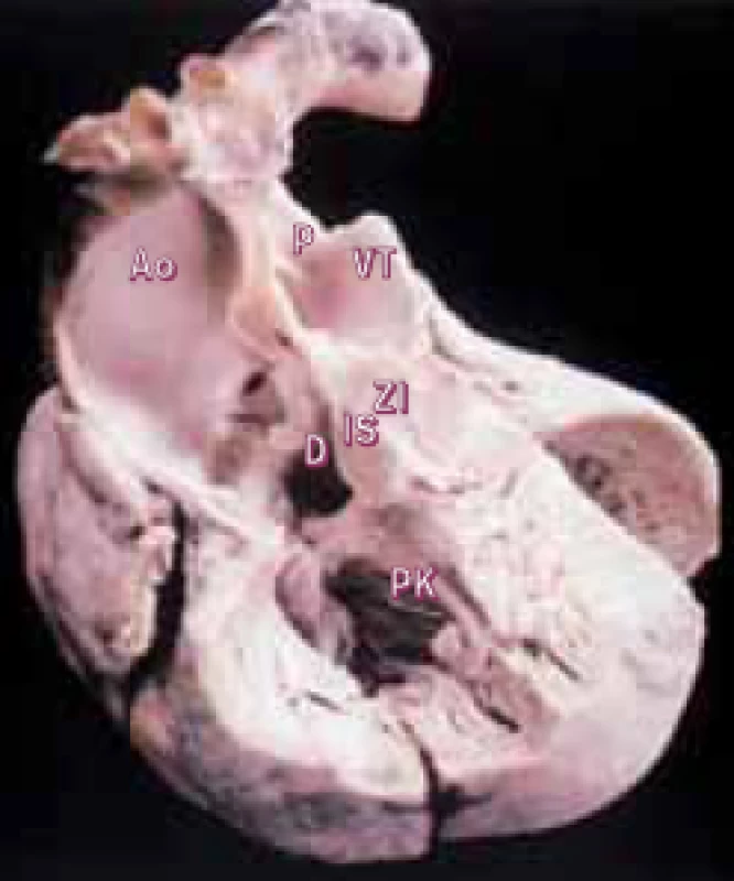 Fallotova tetralogie z předního pohledu, přední stěna pravé komory je odstraněna. Pro extrémní „nasedání“ aorty jsou velké tepny v těsném vztahu.
