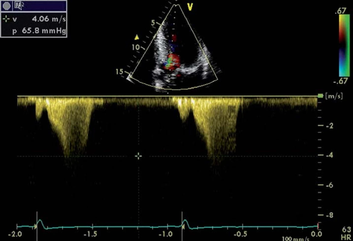 Zobrazení průtoku CW Dopplerem při obstrukci LVOT u nemocného hypertrofickou kardiomyopatií.