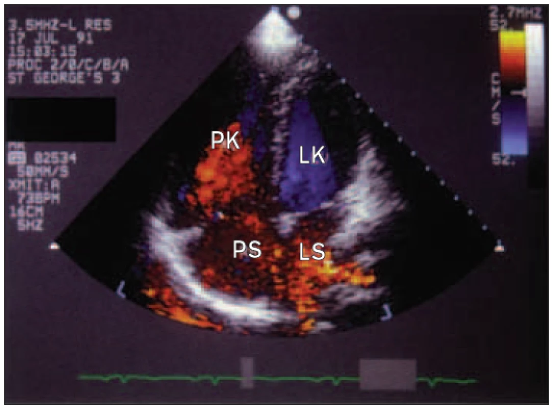Apikální 4dutinový 2D-pohled barevnou dopplerovskou echokardiografií na defekt typu ostium secundum. Krev může téct z dilatovaných plicních žil přes defekt přímo do pravé síně.