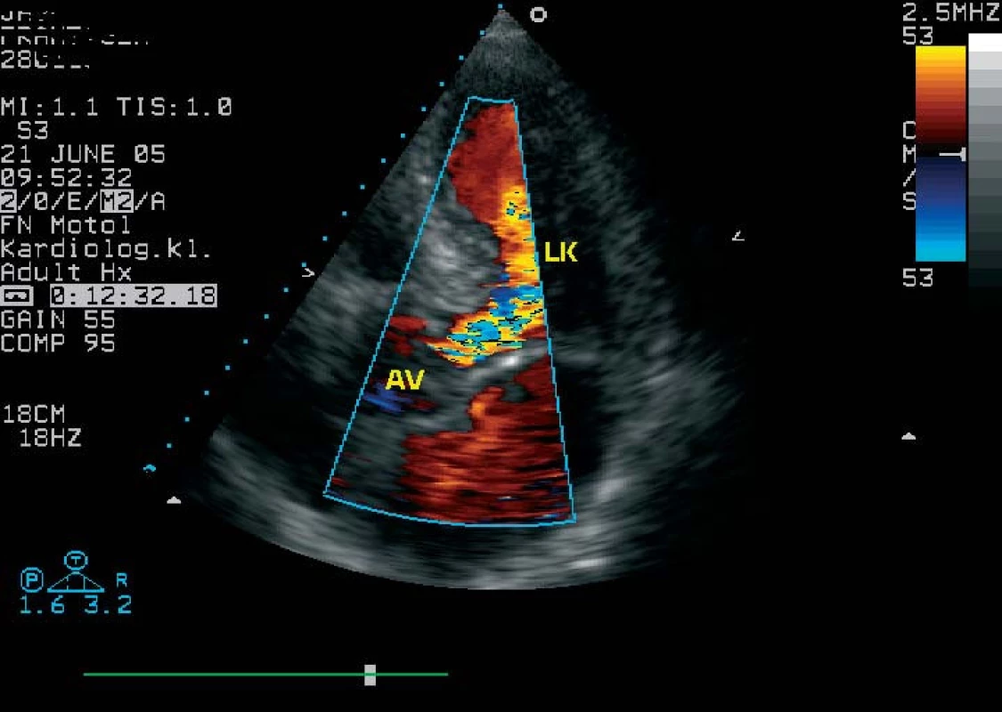 Transtorakální echokardiogram. Barevné dopplerovské zobrazení v apikálním čtyřdutinovém pohledu ukazuje široký „jet“ aortální regurgitace.