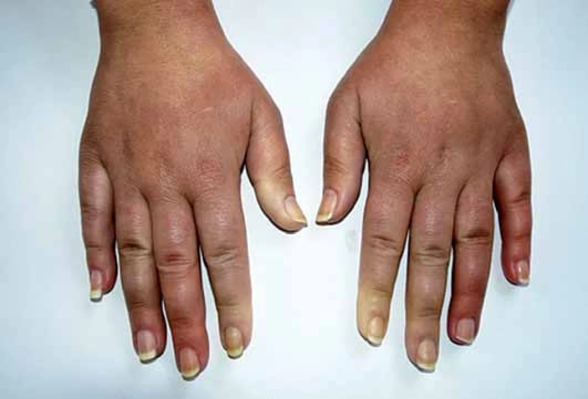 Raynaudův fenomén, difuzní prosáknutí prstů.