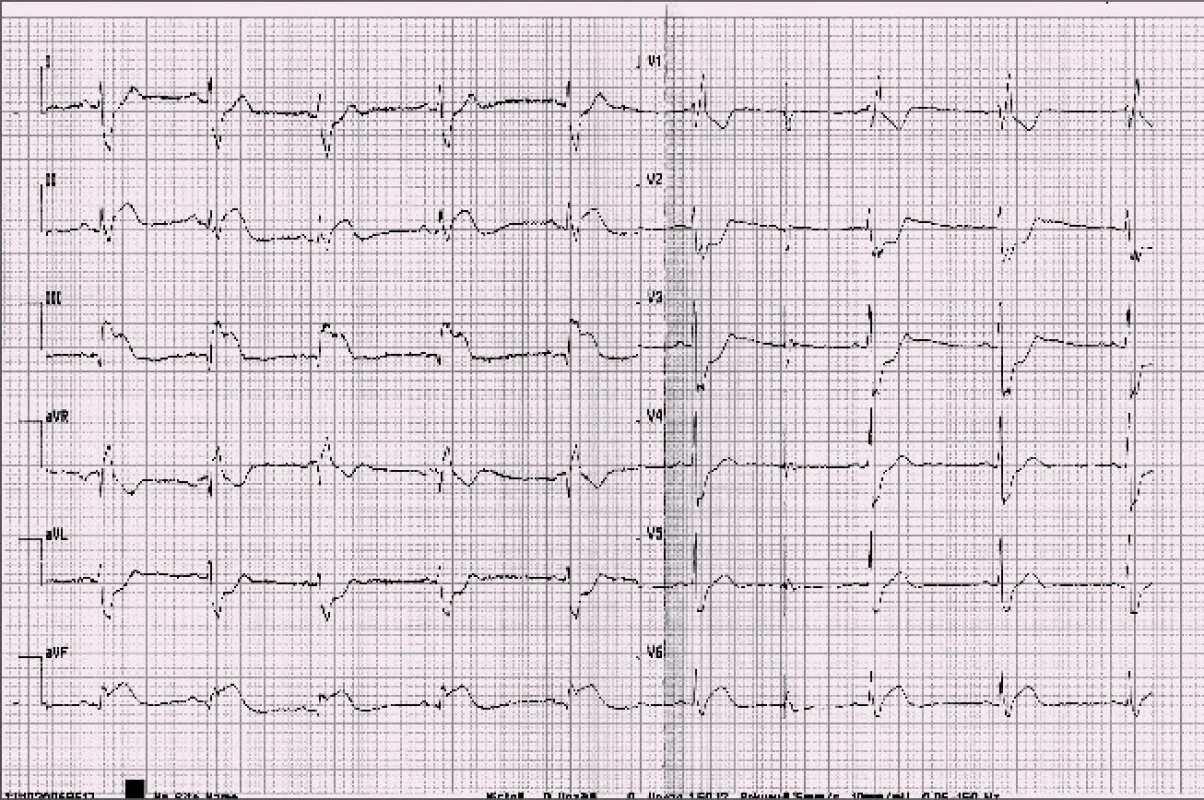 Záznam EKG s obrazem elevací ST segmentu v inferolaterální oblasti a kontralaterálních depresí ST segmentu.