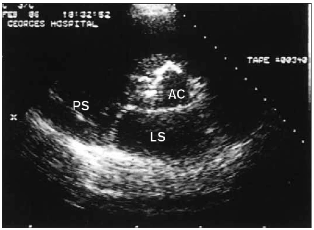 Parasternální sekce krátké osy u případu aortální stenózy. Rozmístění kalcifikací může být někdy i klíčem k etiologii: diagonální pruh poukazuje na bikuspidální aortální chlopeň.