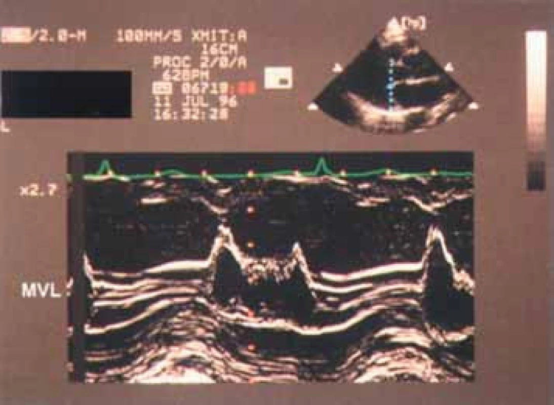 Zvětšený záznam M-modu mitrální chlopně ukazující klasické jemné chvění (flutter) předního cípu sdruženého s aortální regurgitací. Někdy je vidět na septálním endokardu v závislosti na směru jetu.