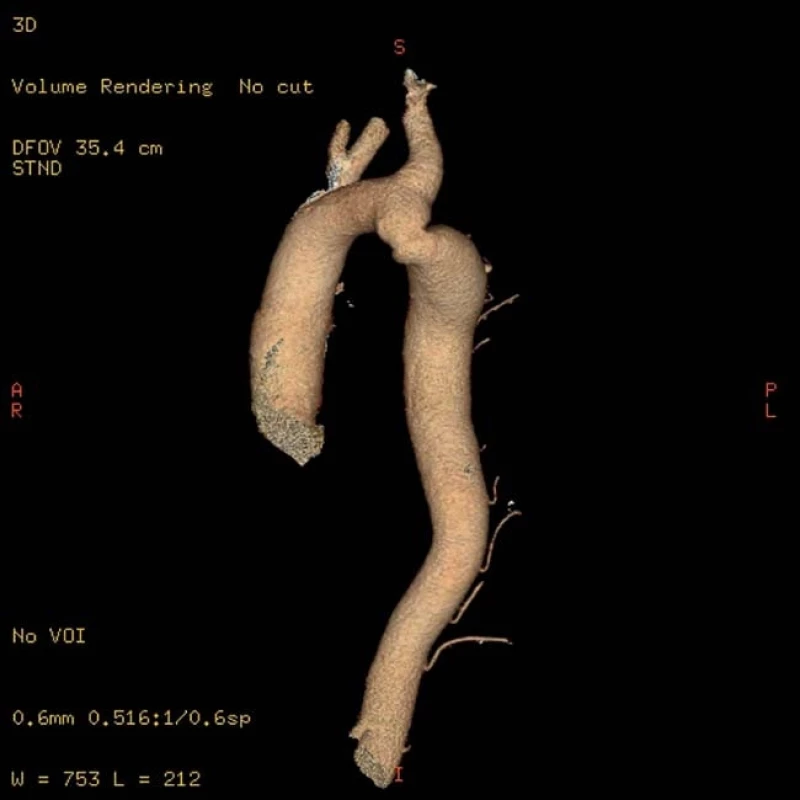Koarktace aorty diagnostikovaná u 58letého muže s rezistentní hypertenzí (zjištěnou od 18 let a léčenou od 28 let). Převzato z [10].
