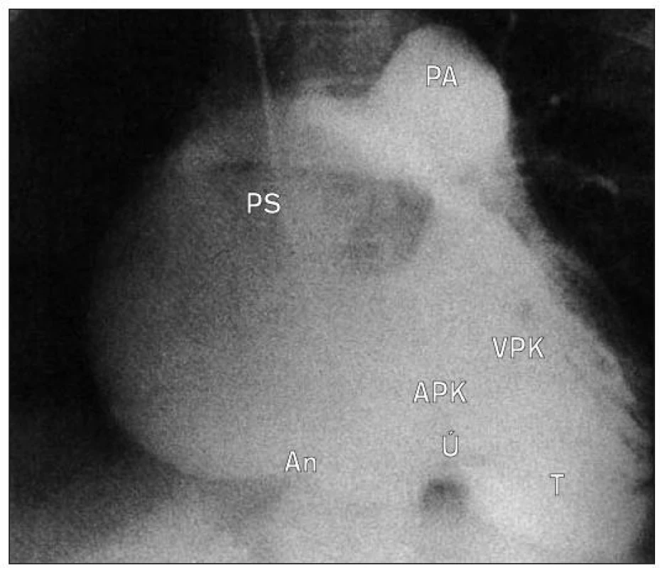 Angiogram pravé komory v antero-posteriorní projekci u Ebstrinovy anomálie při injekci kontrastu do výtokové části PK. Při regurgitaci dolů přemístěné trikuspidální chlopni se zaznamená jak pravý atrioventrikulární prsten tak faktické ústí. Pravá síň je dilatovaná. Tento pacient měl přídatnou stenózu pulmonální chlopně.