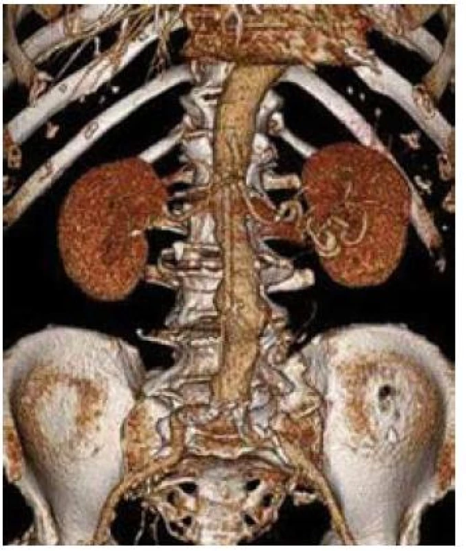 3D CT rekonstrukce obrazu aneuryzmatu břišní aorty s max. průměrem 49 mm.