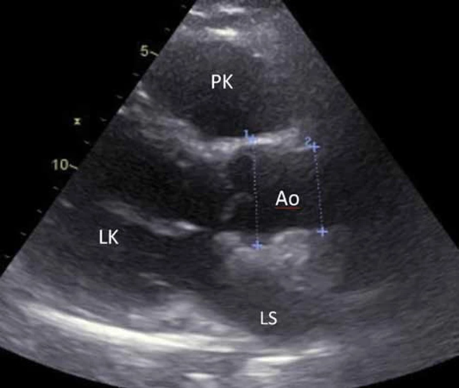 Transthorakální echokardiografie – (PLAX –parasternální dlouhá osa) zobrazující hraniční diametr bulbu aorty – 39 mm (1) a normální diametr ascendentní aorty ve viditelném úseku – 32 mm (2).