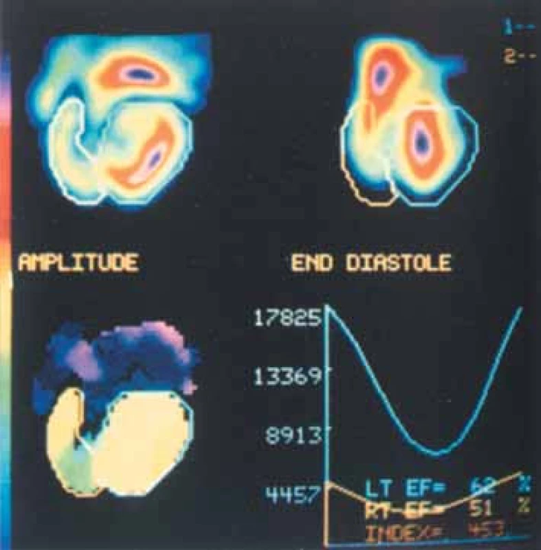 Metoda rovnovážné radionuklidové ventrikulografie v klidu u pacienta s chronickou těžkou aortální regurgitací. Levá komora je dilatovaná s opožděnou kontrakcí na fázovém obraze a abnormální hodnotou amplitudy na horním septu. Regurgitační index 4,53 je velmi zvýšen (normálně 1–1,7).
