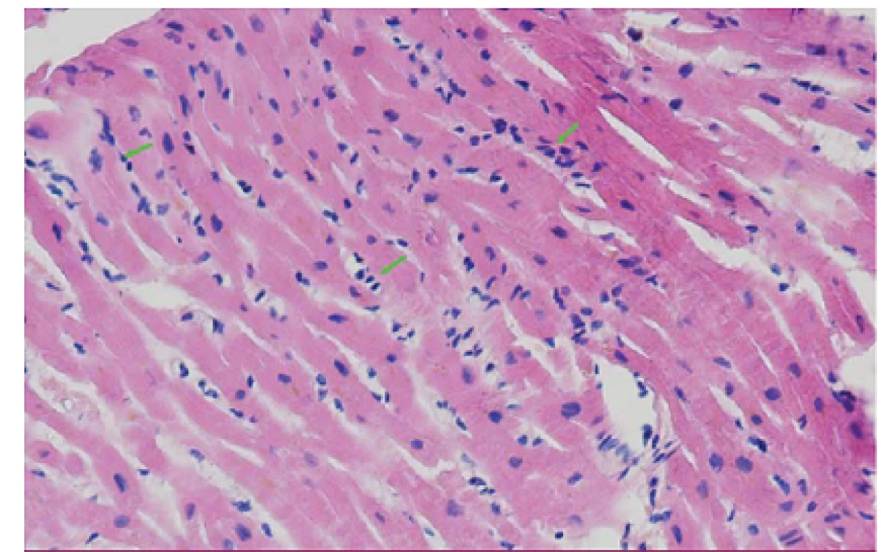Histologický vzorek myokardu s disperzními proužky rejekční celulizace (rejekce grade 1R) v barvení hematoxylin – eosin.
