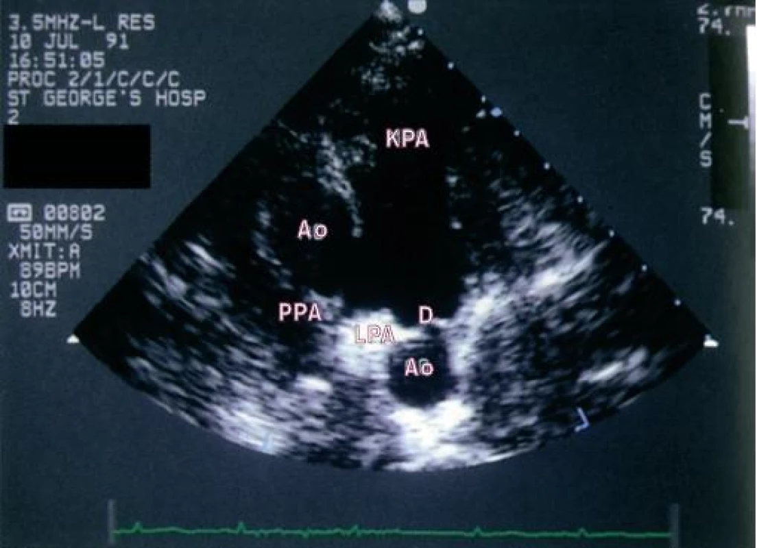 Parasternální 2D-pohled krátké se u dítěte s perzistující dučejí. Řez ukazuje ascendentní a descendentní větev aortálního oblouku. Dučej spojuje sestupnou hrudní aortu s plicní tepnou na úrovni bifurkace.