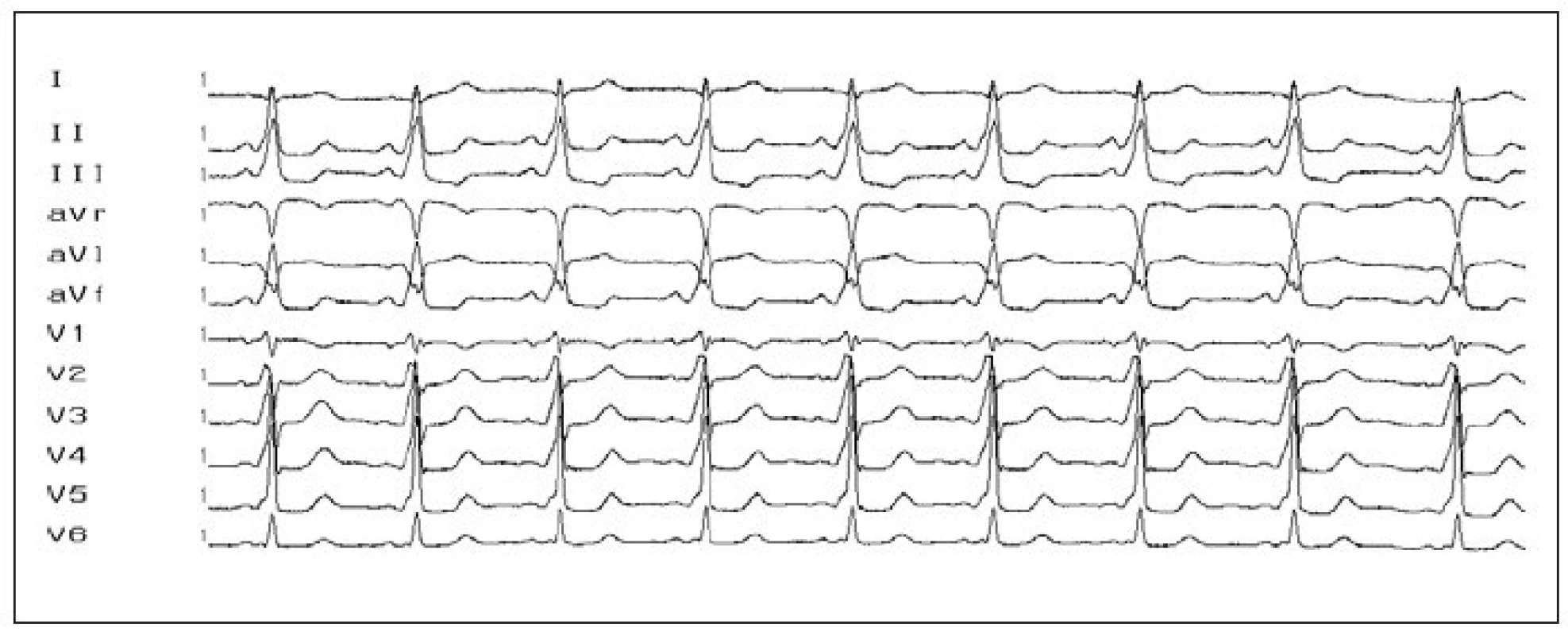 12svodové EKG s obrazem preexcitace. Obraz preexcitace (vlna delta, krátký PQ-interval a široký QRS-komplex) u pacienta s akcesorní AV-spojkou na levé volné stěně (negativní delta-vlna ve svodech I, aVL, obraz pseudoblokády pravého Tawarova raménka).