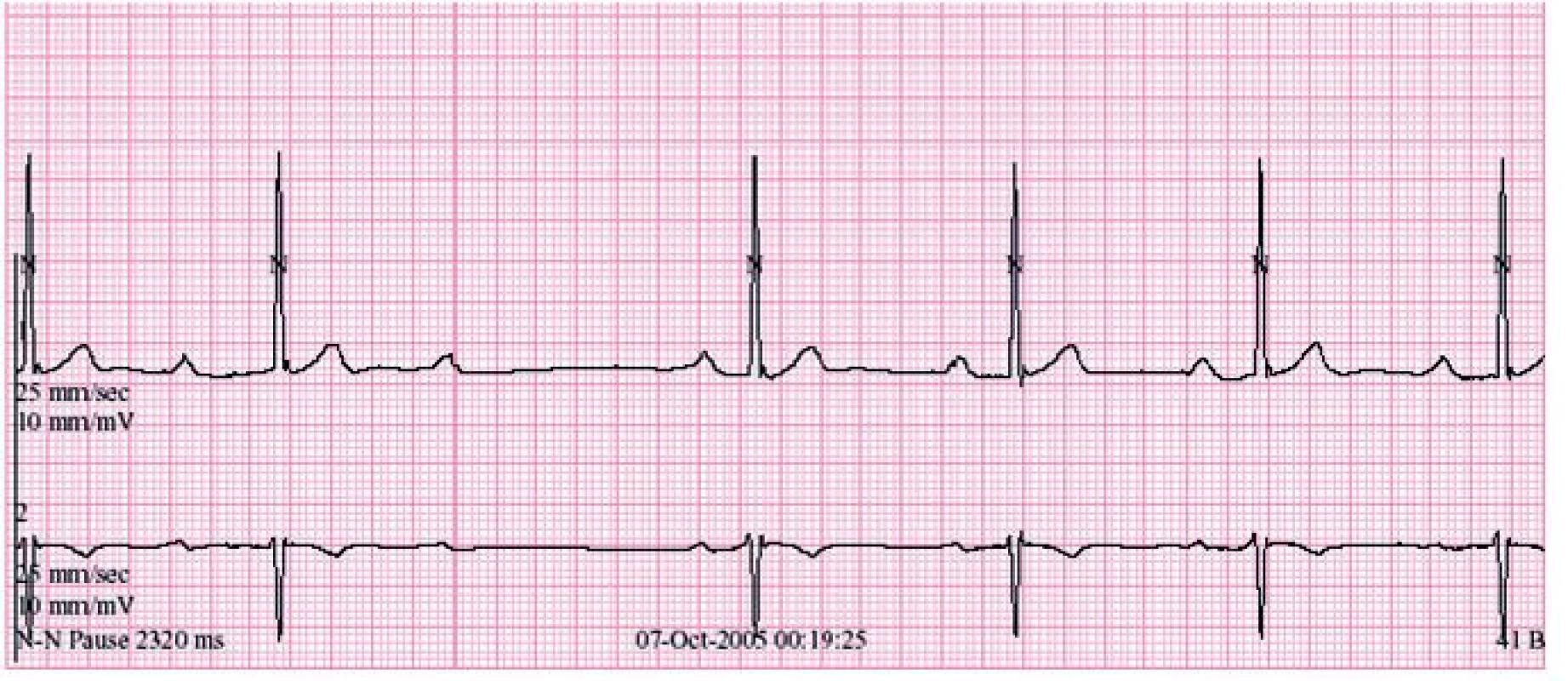 Záznam AV-blokády II. stupně Wenckebachova typu v nočních hodinách při holterovské monitoraci EKG (48letý sportovec, jehož EKG-křivka je na obr. 1).