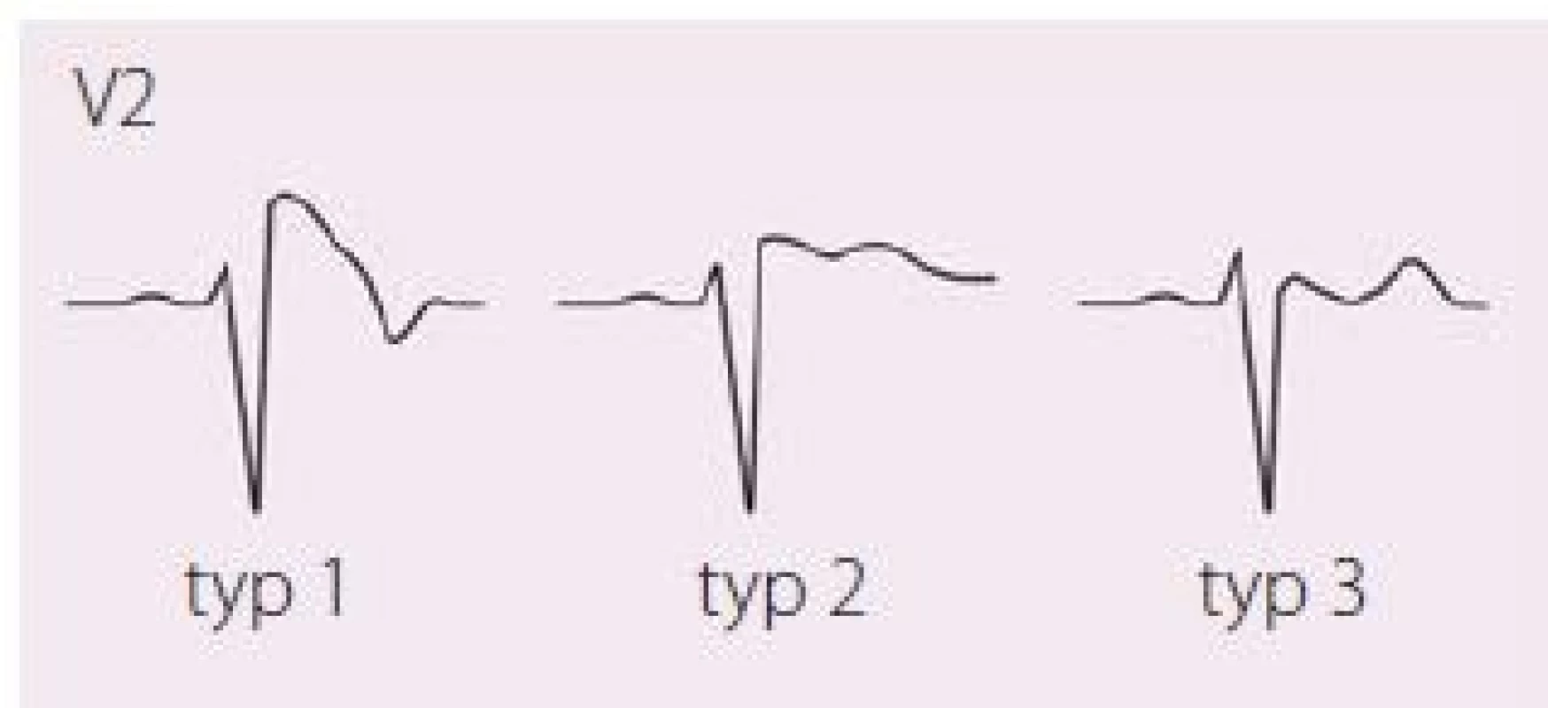 EKG projevy Brugada syndromu, jediný „diagnostický“ je typ 1, tj. ST elevace ≥ 2 mm následovaná negativní vlnou bez izoelektrické nebo s minimální izoelektrickou linií, zvaný také „Coved type“; další dva typy nazýváme „Saddle back“ – typ 2 má mít výše J bod než T vlnu, typ 3 naopak. Upraveno dle [21,22].