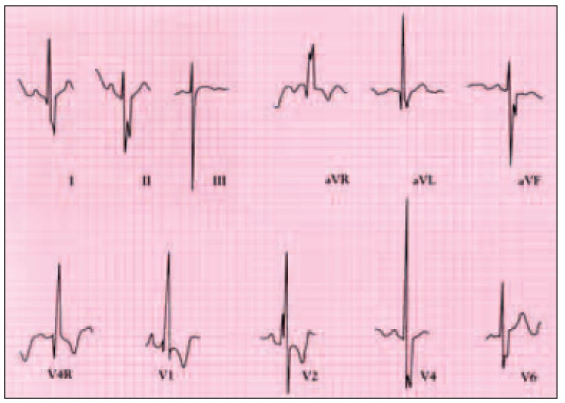 Elektrokardiogram pacienta s defektem septa síní typu ostium primum ukazuje deviaci osy doleva a blokádu pravého raménka.