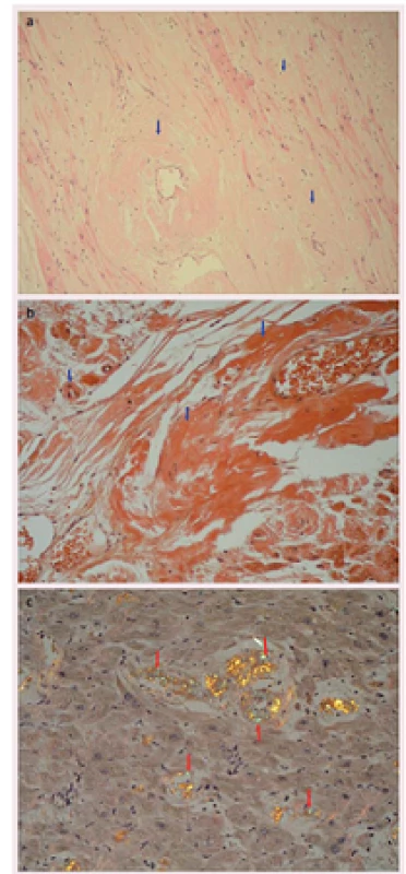Histologický vzorek myokardu z endomyokardiální biopsie ukazující depozita amyloidu (šipky) v barvení hematoxylin – a) eosin, b) kongo červeň, c) kongo červeň v polarizovaném světle.