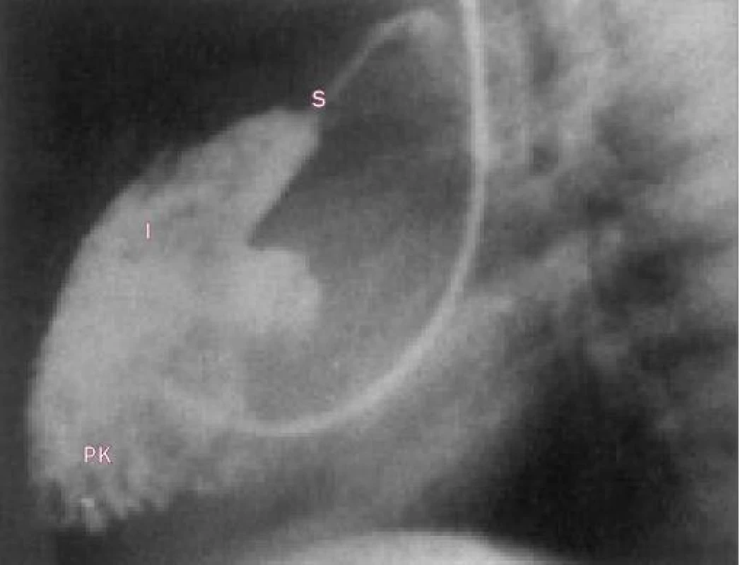 Angiogram pravé komory v laterální projekci u stenózy plicnice ukazuje ztluštělou a vyklenutou chlopeň s centrálním systolickým jetem.