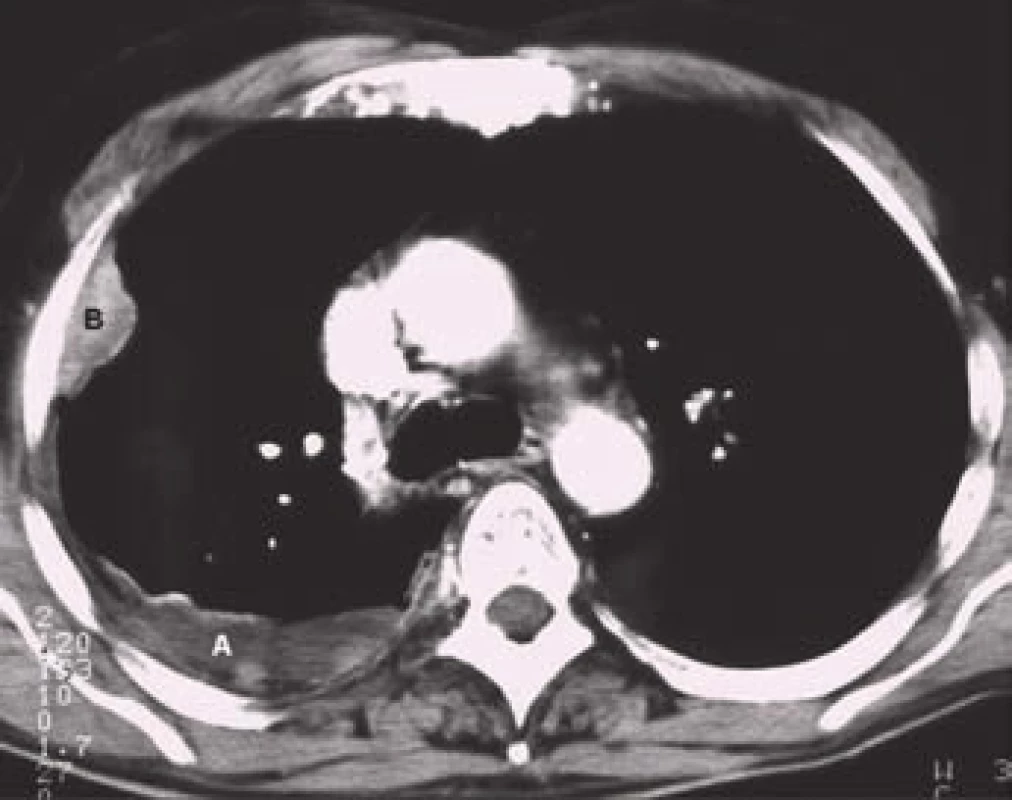 CT obraz pleurálního výpotku (A) při nádorovém procesu naléhajícím na hrudní stěnu (B).