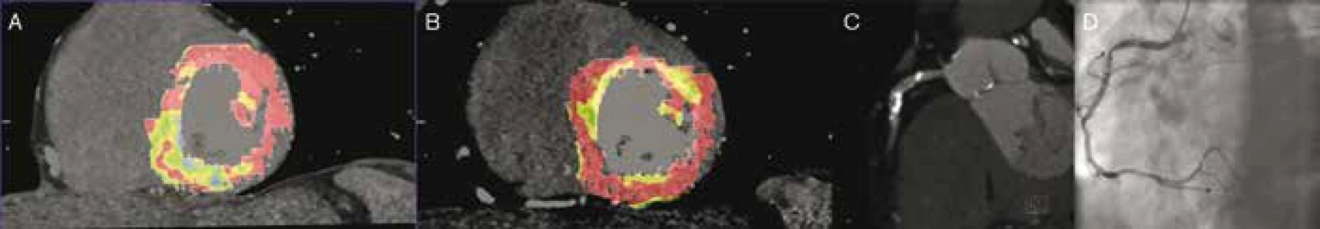 Perfuzní CT + CTA + SKG: asymptomatický pacient bez anamnézy ICHS před pánevní cévní rekonstrukcí. Perfuzní deficit inferoseptální oblasti při zátěžovém perfuzním CT vyšetření (A) a normální perfuze při klidovém vyšetření (B). Příčinou zátěží podmíněné hypoperfuze byla stenóza proximální ACD (CT angiografie – C, koronarografie – D).