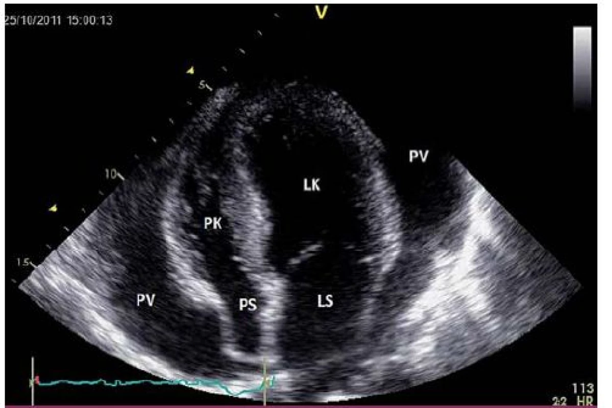 Echokardiografie u srdeční tamponády s útlakem pravé síně (hrotová čtyřdutinová projekce).
