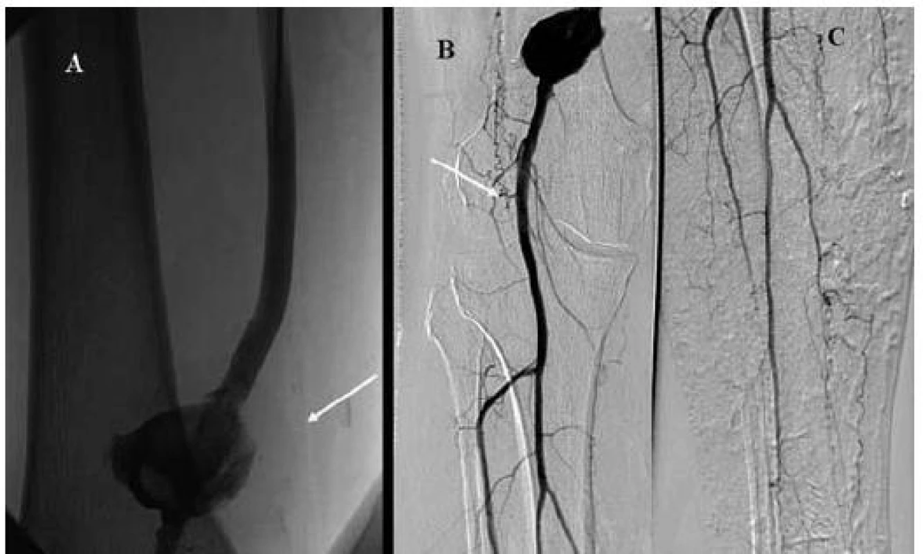 Kontrolní angiografie po 24 hod trombolýzy prokazuje průchodný bypass (panel A) a velké pseudoaneuryzma v mistě minulé implantaci stentu (panel B) a dobře průchodné bércové tepny (panel C).