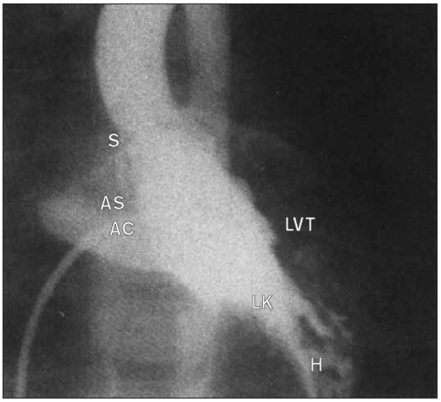 Systolický rámeček u pacienta z obrázku 32 ukazuje ztluštělou kopulovitou chlopeň.