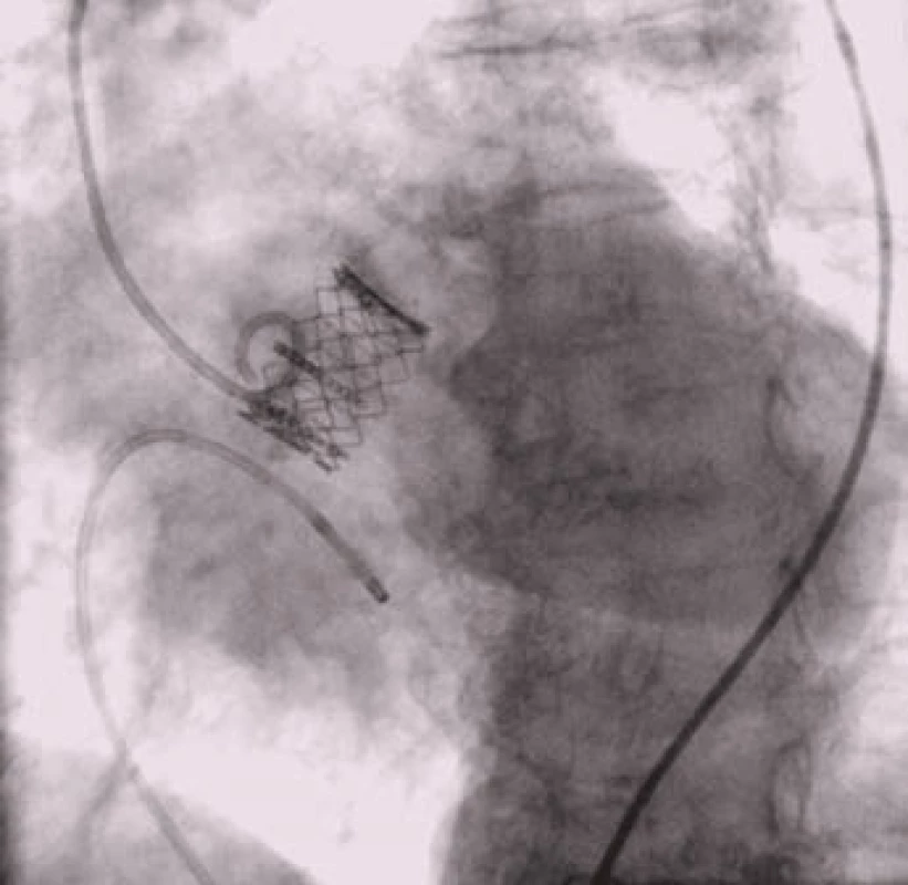 Implantovaná chlopeň Edwards-Sapien v aortální pozici.