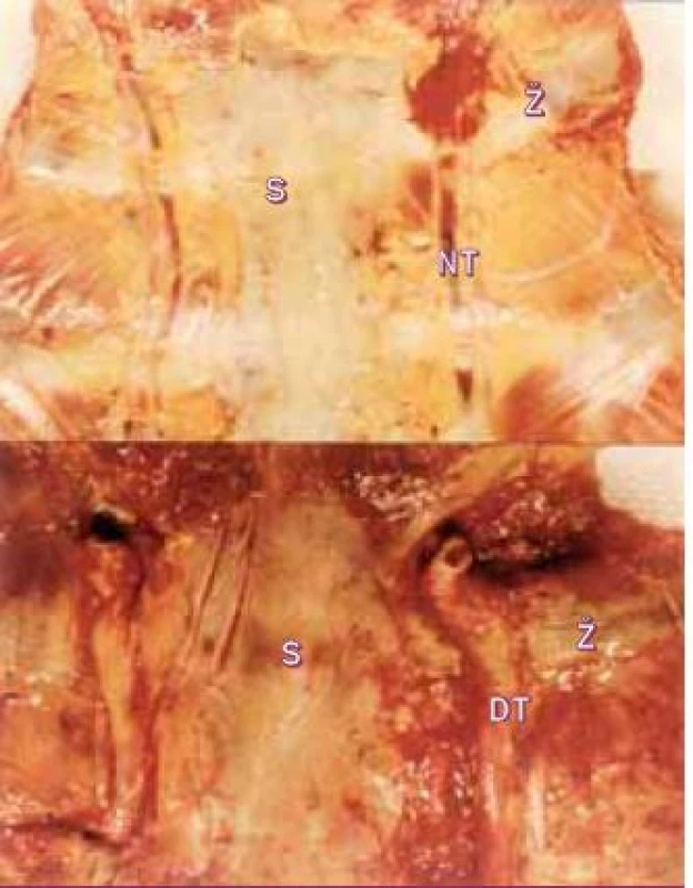 Panel ukazuje podél sterna probíhající obě vnitřní mamární arterie u normálního pacienta a pacienta s koarktací, kde jsou vlivem kolaterálního toku značně dilatované.