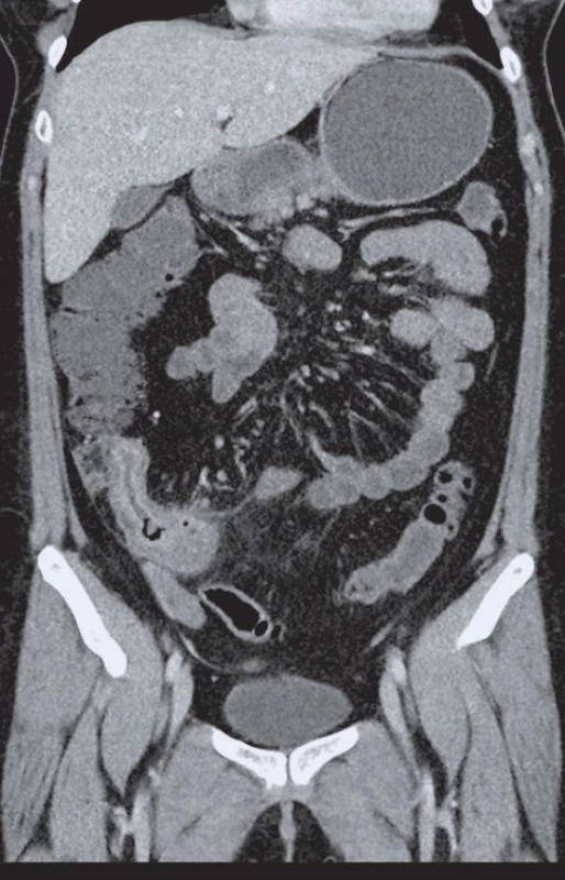 CT enterografie. Pacientka s Crohnovou chorobou v ileocékální lokalizaci, stenózou a ztluštěním terminálního ilea.