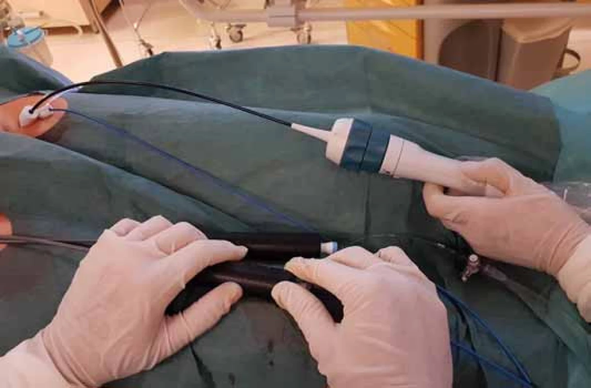 Ultrazvukový katetr zavedený do srdce přes femorální žílu (11F sheath).