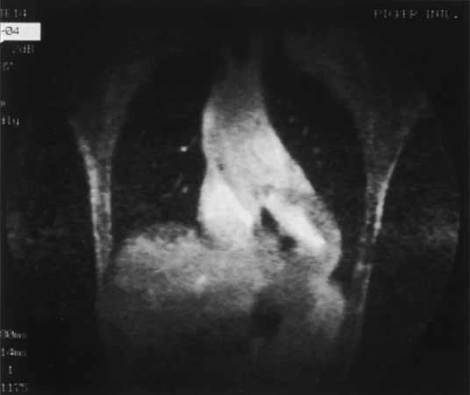 Gradient echo MR u aortální regurgitace. Proximálně od aortální chlopně je vidět v diastole intenzivní ztráta signálu vlivem regurgitace.
