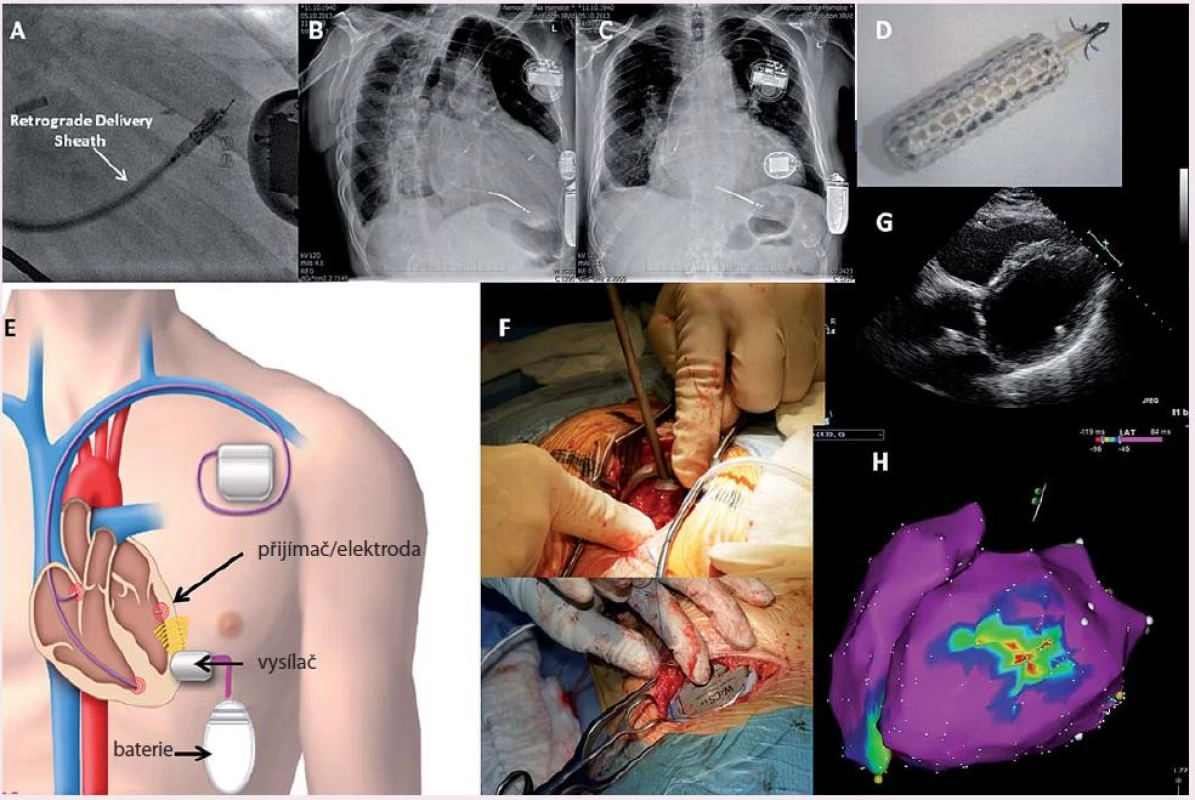 a) RTG skiaskopický záznam transaortálního přístupu k implantaci transmiteru UZ-stimulační energie v oblasti endokardu boční stěny LK, katetr je vybaven atraumatickým nonkompliantním balónkem k omezení rizika perforace srdeční stěny; b, c) RTG obrázek v různých projekcích implantovaných elementů WiSE a původně implantovaného standardního dvoudutinového ICD systému; d) stimulační element s polyesterovým krytím povrchu; e) schematické znázornění funkce WiSE CRT; f) implantační procedura transmiteru s obrazem operačního pole mezižeberní krajiny, kam se implantuje plastové lůžko pro vysílač UZ energie; g) echokardiografický obraz ve čtyřdutinové podélné ose, na laterální stěně je patrný implantovaný stimulační element; h) Carto mapa s nejčasnější aktivací na laterální stěně v místě implantovaného stimulačního elementu a apexu PK, kde je implantovaná původní defibrilační elektroda. Převzato z [31].
