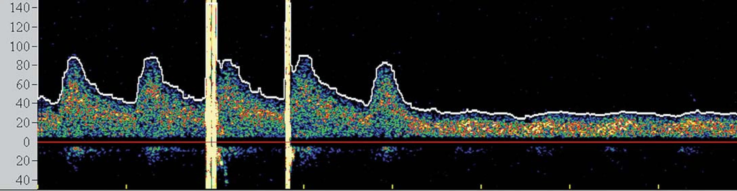 Spektrální křivka znázorňující pokles průtoku a ztrátu pulzatility ve střední cerebrální arterii po zavedení clampu.
