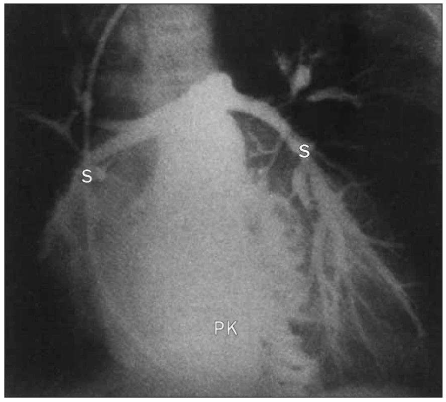 Angiogram pravé komory v antero-posteriorní projekci u téhož pacienta (37) ukazuje stenózu plícnice.
