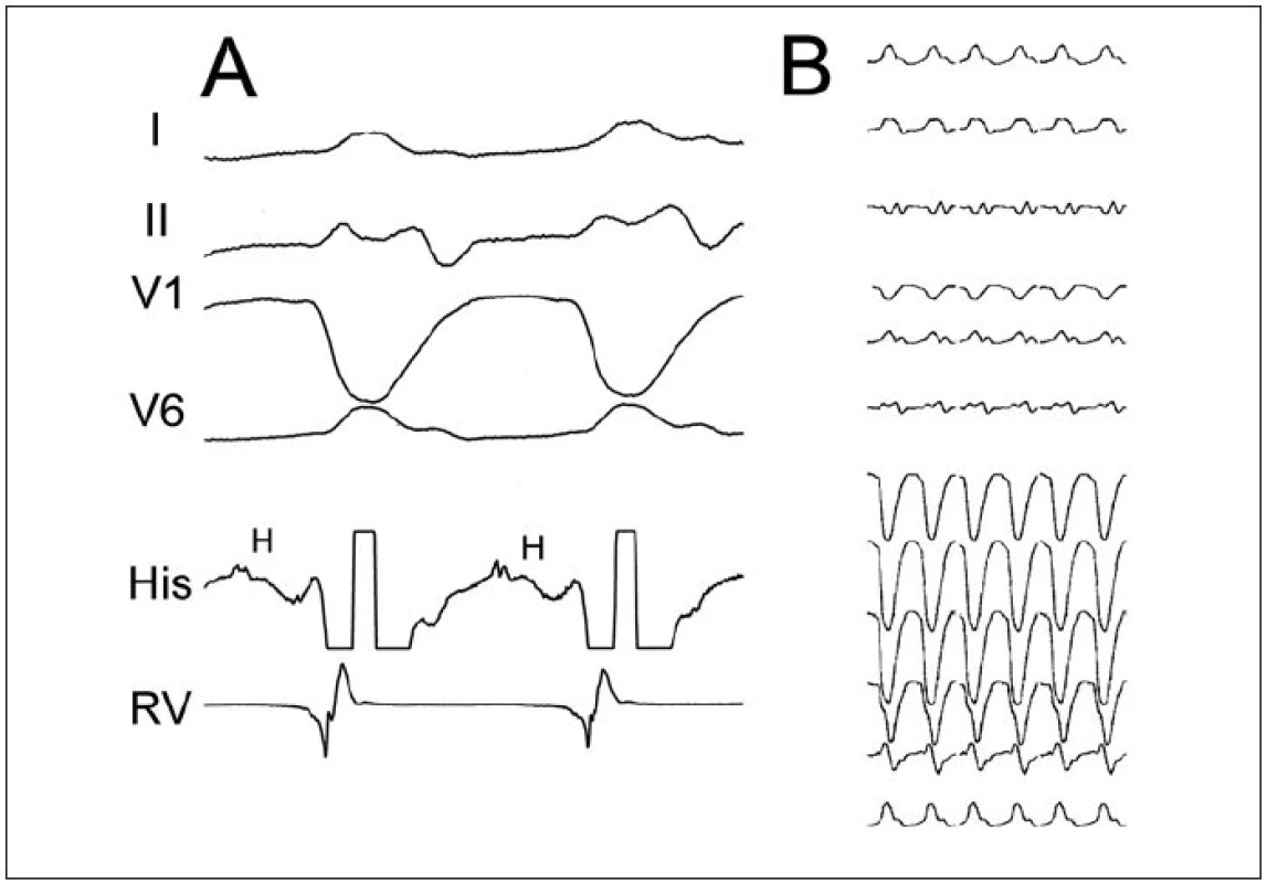 Komorová tachykardie typu raménkové reentry. Panel A ukazuje vybrané EKG-svody a intrakardiální elektrogramy z oblasti Hisova svazku (His) a pravé komory (RV). Panel B přibližuje typickou morfologii na 12svodovém EKG (morfologie blokády levého raménka Tawarova se širokými komplexy QRS, často s malým kmitem r v iniciální části a v tom případě s úzkým kmitem rS, který kontrastuje s jinak velmi širokým komplexem QRS). Jednou z diagnostických známek je přítomnost potenciálu Hisova svazku (H) před každým komorovým potenciálem při KT a trvání HV-intervalu při KT delší než při sinusovém rytmu.